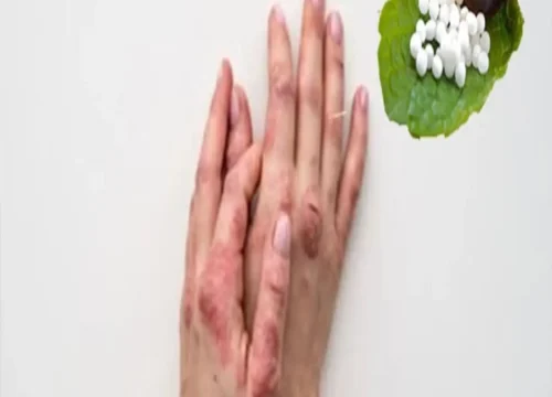 Skin Treatment