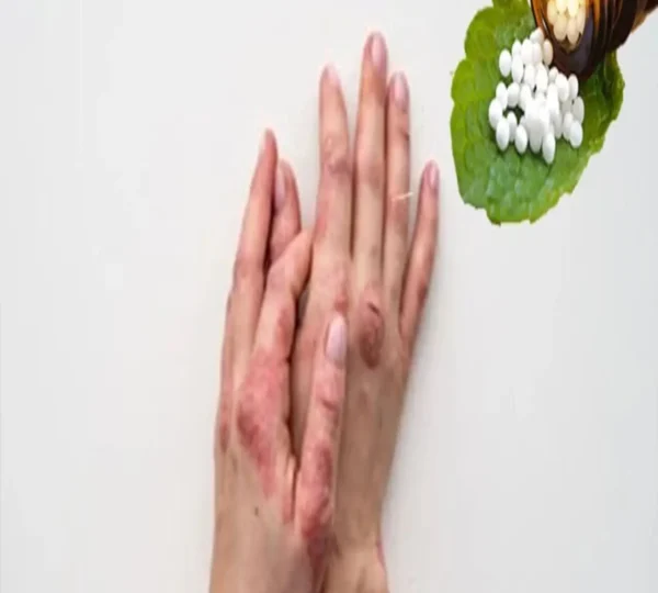 Skin Treatment